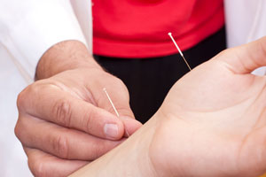 A hand is getting acupuncture needles pushed into it