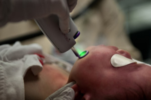 A surgeon at the Beckman Laser Institute; Medical Clinic treats an 8-month-old's port-wine stain with a DCD-equipped laser.