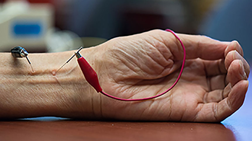 Image of a wrist with two acupuncture needles in it