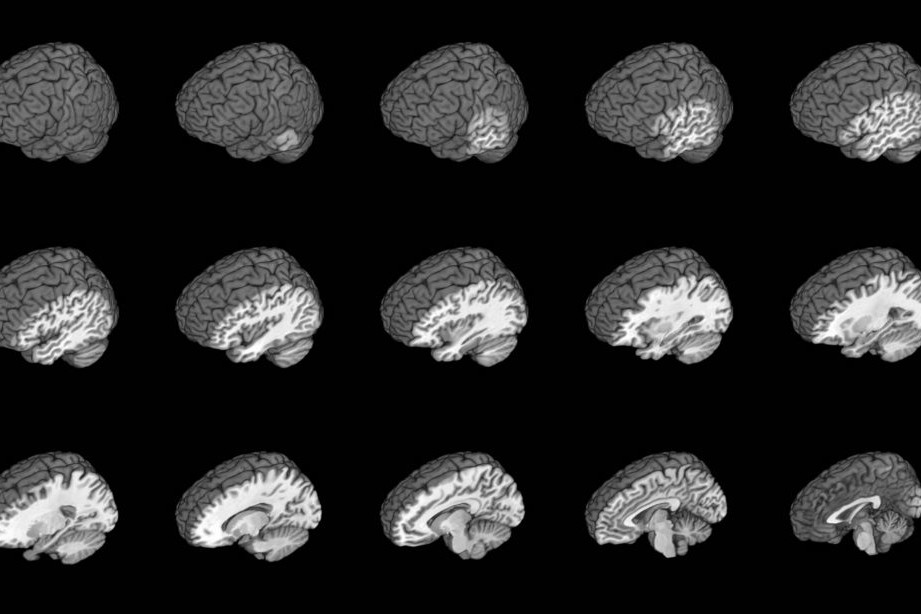 Multiple MRI brains